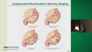 What is diverticulitis Causes symptoms treatment amp more [upl. by Esinrahs88]