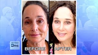 See Woman’s Incredible Before and After Facial Rejuvenation [upl. by Ileana595]