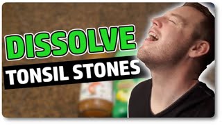 Dissolve Tonsil Stones At Home With Only 3 Ingredients [upl. by Feola284]