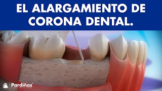 Alargamiento de corona dental © [upl. by Zoubek]