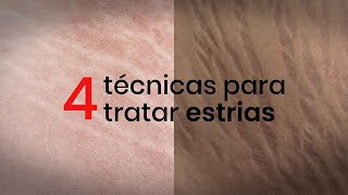 4 técnicas para tratar estrias [upl. by Obed]