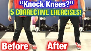 quotKnock Kneesquot Genu Valgum 5 BEST CORRECTIVE EXERCISES  Dr Wil amp Dr K [upl. by Gurango]