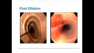 Eosinophilic Esophagitis [upl. by Ailahtan]