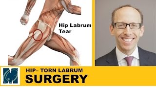 Hip Pain  Torn Labrum Hip [upl. by Gnivri387]