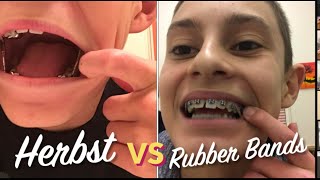 Which Is Better Herbst Appliance VS Rubber Bands [upl. by Darbie241]