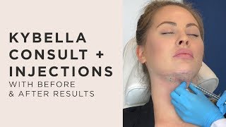 Kybella Consulation amp Treatment Everything You Need to Know [upl. by Uis332]