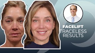 10 YEARS YOUNGER Traceless Facelift Surgery Before and After  Dr David Stoker [upl. by Grannia481]