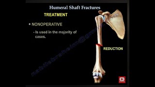 Humerus Fractures  Everything You Need To Know  Dr Nabil Ebraheim [upl. by Dnalyaw]