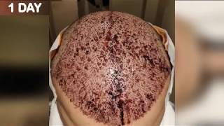 Hair Transplant Post Op Care Instructions  HRBR  Hair Restoration Blackrock [upl. by Sassan]