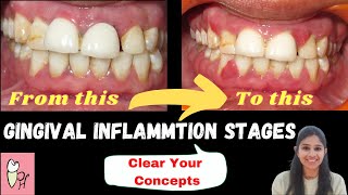 GINGIVITIS ‖ Stages Of Gingival Inflammation ‖ Perio Hub ‖ Dr Sneha [upl. by Laspisa]