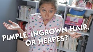 Pimple Ingrown Hair or Herpes [upl. by Appledorf481]