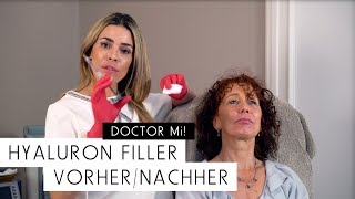 Hyaluron Filler Vorher  Nachher  DOCTOR MI Folge 9 [upl. by Shargel]