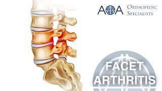 AOA Orthopedic Specialists  Facet Arthritis [upl. by Rednasxela985]