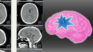 Brain Eating Amoeba by getting water up your nose [upl. by Reuven]