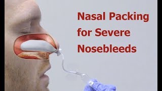 Nasal Packing for Severe Nosebleeds [upl. by Eelsew]