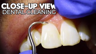 Dental Cleaning  CloseUp View ASMR [upl. by Chavaree2]