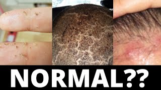 I Got A Hair Transplant  My Emotional Female Hair Transplant Surgery Experience [upl. by Yggam]