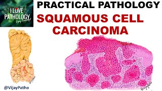 SQUAMOUS CELL CARCINOMA Clinical features amp Morphology Premalignant lesions [upl. by Coral]