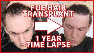 After Hair Transplant Does Hair Grow in Stages [upl. by Leverett905]