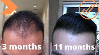 Female Hairline Lowering Hair Transplant 1 Year After  Dr Matt Huebner Meagan [upl. by Hgielar]