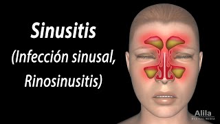 Sinusitis Animación Alila Medical Media Español [upl. by Lipinski600]