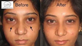 Under Eye Fillers [upl. by Etem]