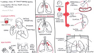 Lung Cancer  Overview [upl. by Esinej]