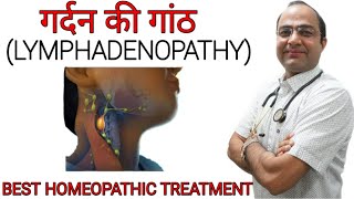 Swollen lymph nodes  Lymphadenopathy  गर्दन की गाँठ  Neck nodes swelling [upl. by Fenton42]