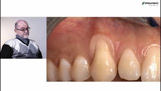 Prof Giovanni Zucchelli Treatment of class I gingival recession [upl. by Tearle]