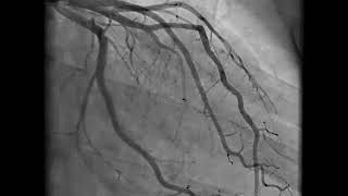 Coronary Angiogram Procedure [upl. by Rabush]