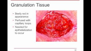 WoundRounds Free Webinar  PUSH Tool for Monitoring Pressure Ulcer Healing A Practical Guide [upl. by Farleigh215]