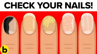 What Vitamin are you lacking when you have brittle nails  Dr Priya J Talageri [upl. by Murry140]