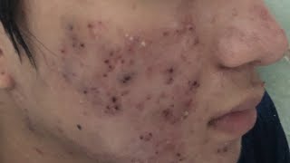 Blackheads Removal 332b  Loan Nguyen [upl. by Marcile]