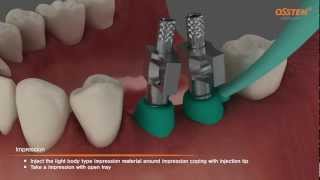 TSIII Fixture Placement amp Impression taking Pickup and Transfer Impression Copings [upl. by Aidnic]