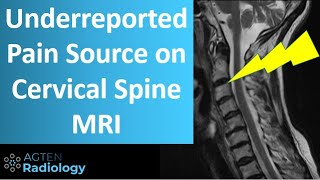 Cervical Spine Facet Pain on MRI [upl. by Tanny819]