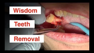 Wisdom Teeth Removal [upl. by Juliette256]