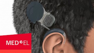 How Do Cochlear Implants Work The SYNCHRONY Cochlear Implant  MEDEL [upl. by Larret114]