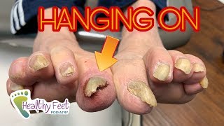 Why Its Important to Get Your Nails Trimmed Starring a Loose Nail [upl. by Gothard]