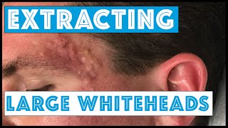 Acne Vulgaris and Extracting large Whiteheads  Part 1 [upl. by Evilo]