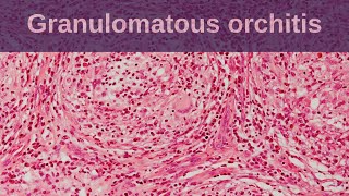 New treatment for granuloma annulare shows promise [upl. by Wenoa]