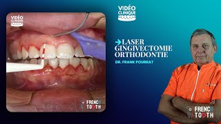 Laser gingivectomie orthodontie  Dr Pourrat [upl. by Nylessoj31]