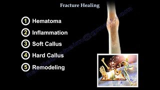 Fracture Healing  Everything You Need To Know  Dr Nabil Ebraheim [upl. by Elisee]