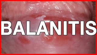 Balanitis Symptoms Causes Treatment and Prevention [upl. by Eetak]