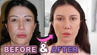 My Face Lift Before and After Part 2 [upl. by Aicilehp]