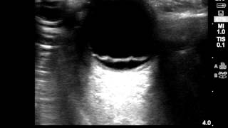 Ocular Ultrasound Retinal Detachment [upl. by Zelma]