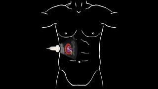 POCUS  Basic Renal Ultrasound [upl. by Hgierb]