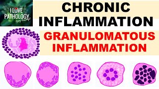 What are Granulomas  Pathology mini tutorial [upl. by Pru]