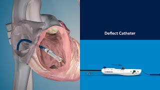 Micra TPS Implant Procedure Animation [upl. by Worrad]