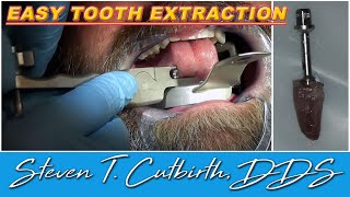 Easy Tooth Extraction  Dental Minute with Steven T Cutbirth DDS [upl. by Kalie]