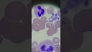 Hematology Patient with low platelets Part 1 [upl. by Aramas]